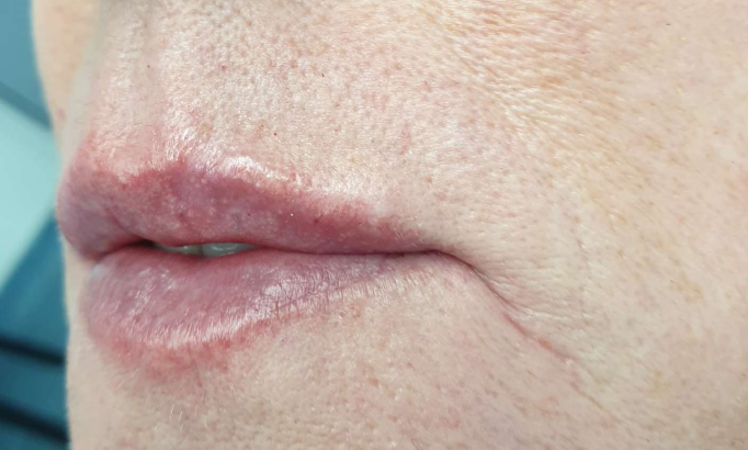 Lip filler - Case 1 after