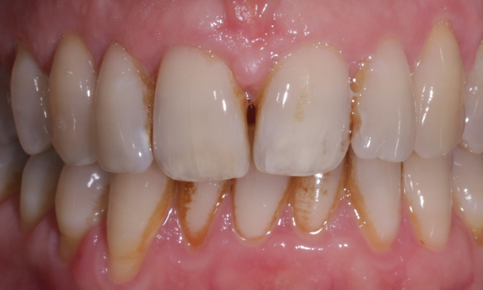 Stain removal - Case 1 before