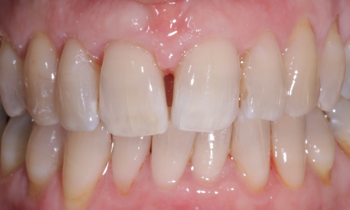 Stain removal - Case 1 after