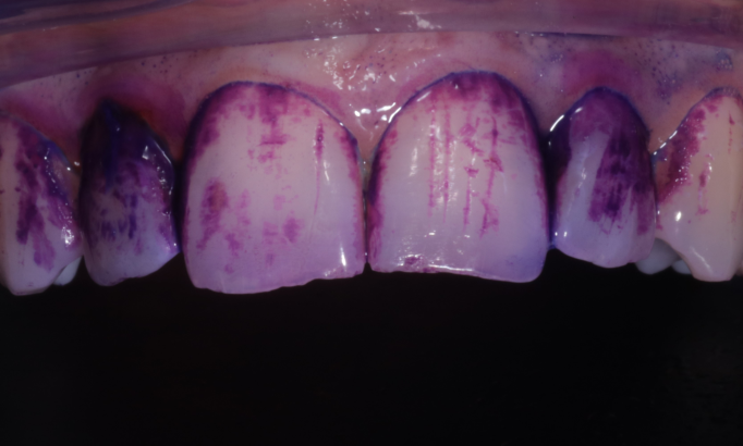 Stain removal - Case 2 before