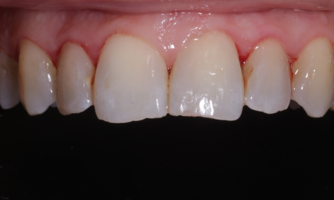 Stain removal - Case 2 after