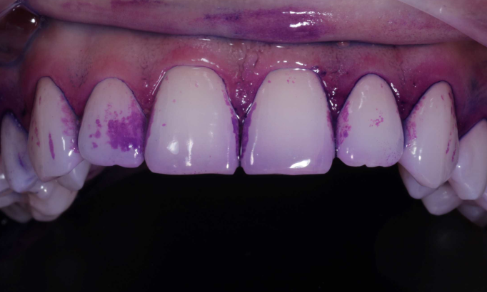 Stain removal - Case 3 before