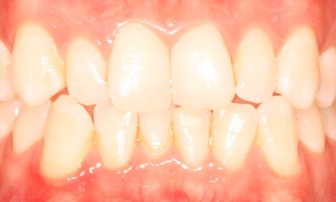 Teeth Alignment - Case 4 before