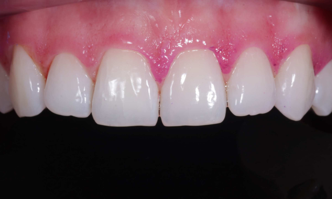 Stain removal - Case 3 after