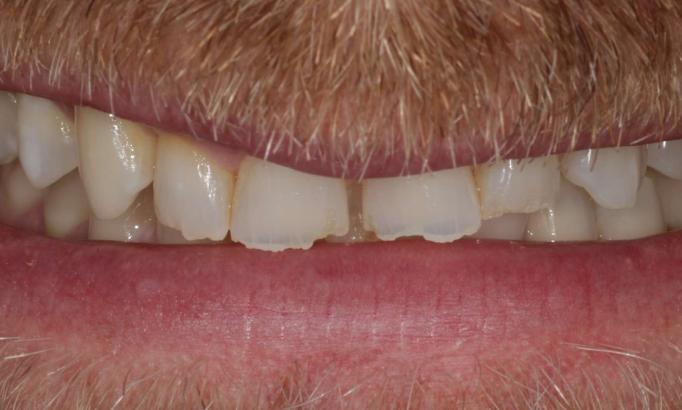 Teeth Whitening - Case 2 before