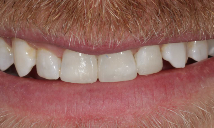 Teeth Whitening - Case 2 after