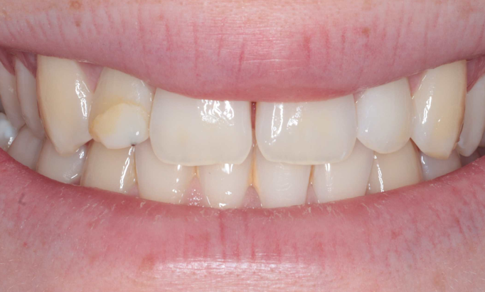 Teeth Whitening - Case 3 before