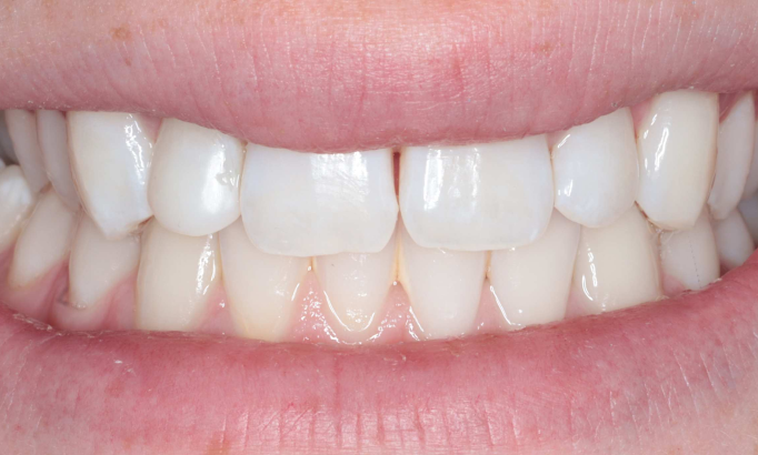 Teeth Whitening - Case 3 after