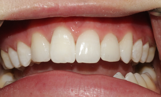 Teeth Whitening - Case 4 after