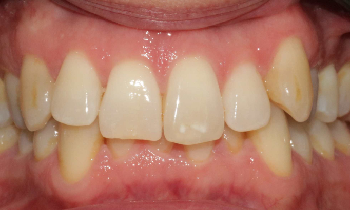 Teeth Whitening - Case 5 before
