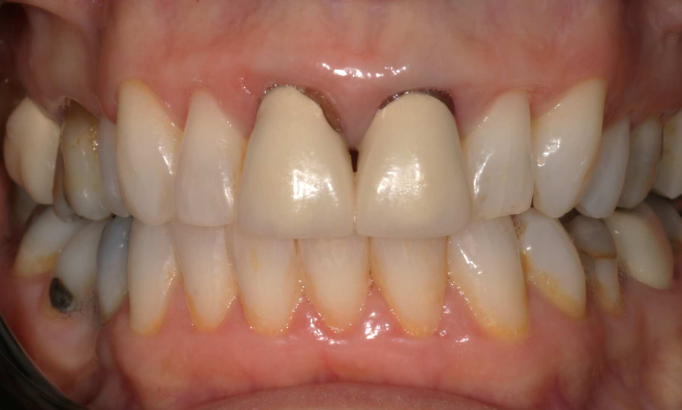 Teeth Whitening - Case 6 before