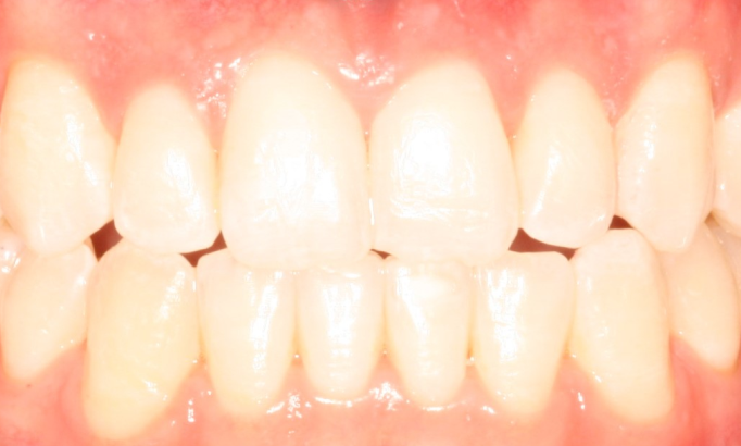 Teeth Alignment - Case 4 after