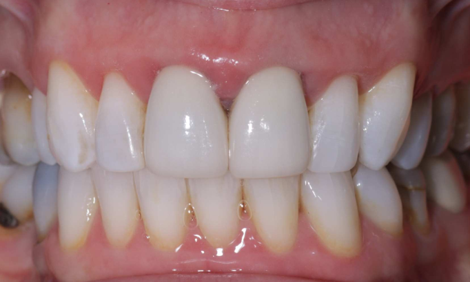 Teeth Whitening - Case 6 after