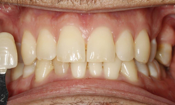 Teeth Whitening - Case 7 before