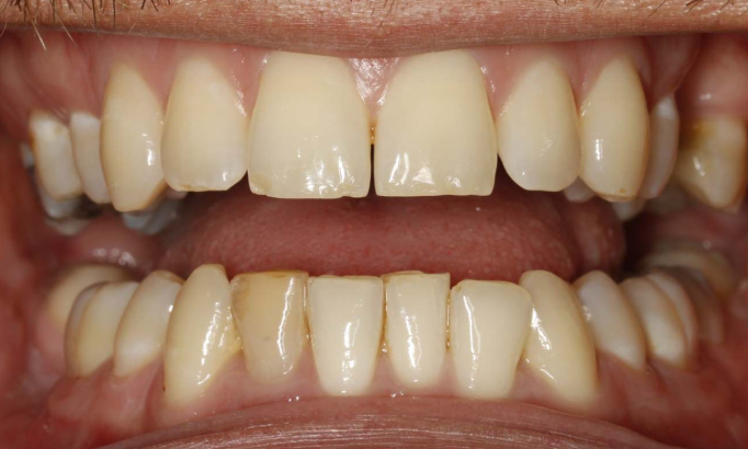 Teeth Whitening - Case 8 before