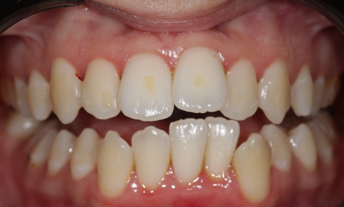 Teeth Whitening - Case 9 before