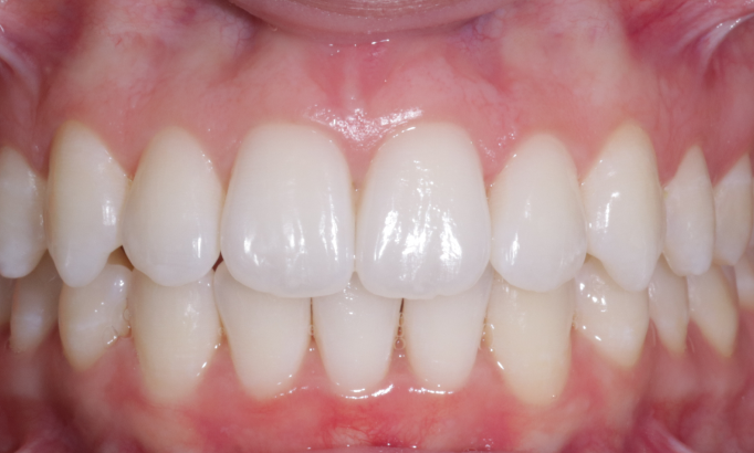 Teeth Whitening - Case 9 after