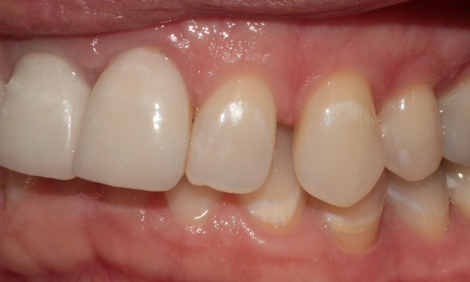 Teeth Alignment - Case 9 before