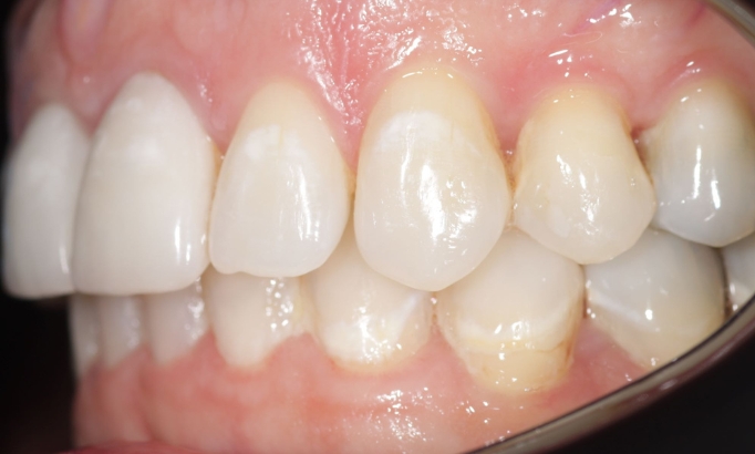 Teeth Alignment - Case 9 after
