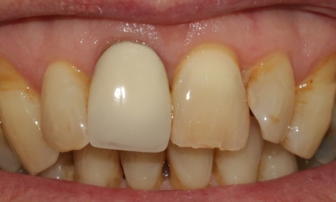 Crowns and bridges - Case 8 before