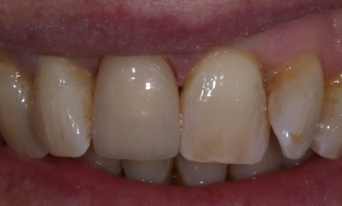 Crowns and bridges - Case 8 after